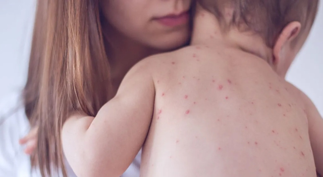 Kızamık yeniden yayılıyor: Avrupa ve Orta Asya’da vakalar yüzde 47 arttı