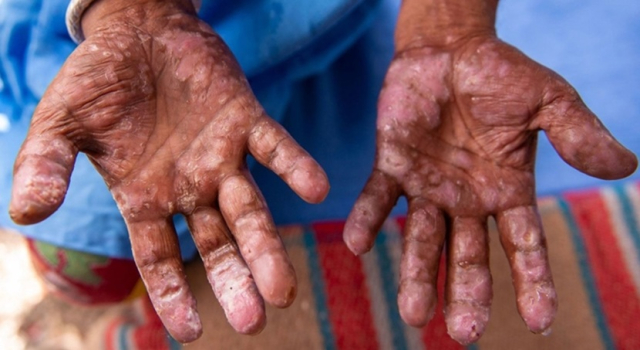 Avrupa’da cüzzam alarmı: 44 yıl sonra ilk vakalar kayıtlara geçti