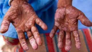 Avrupa’da cüzzam alarmı: 44 yıl sonra ilk vakalar kayıtlara geçti